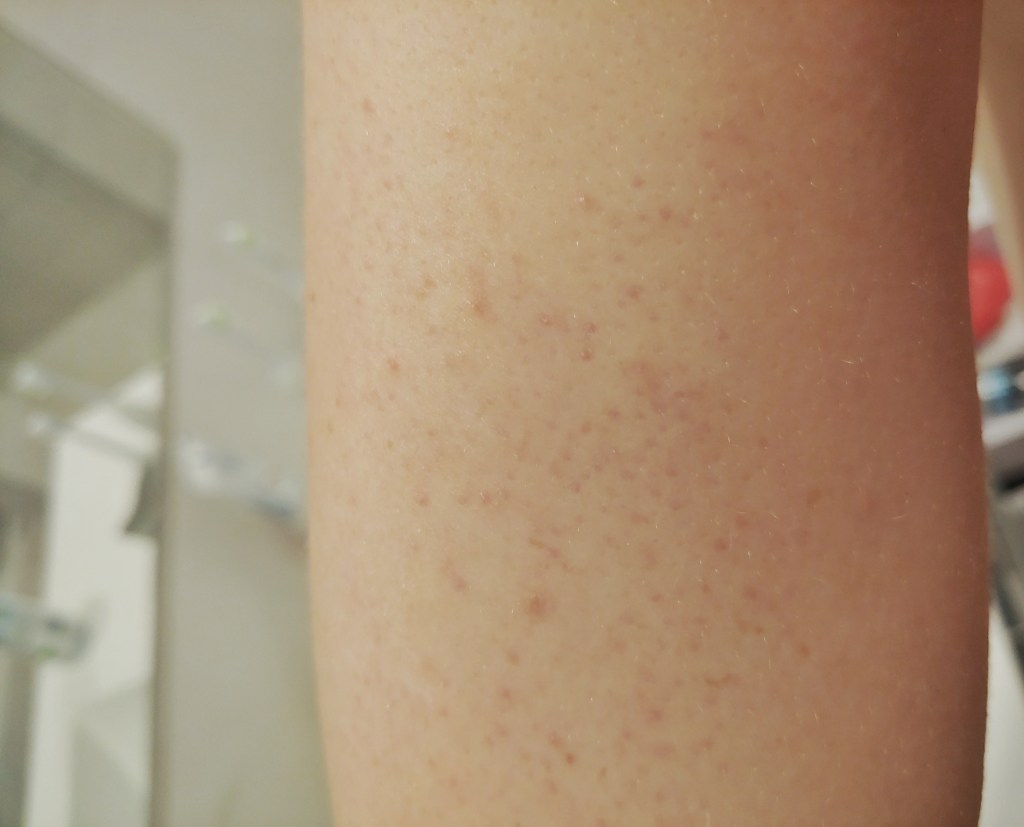 Upper arm tricep area with red dots on the skin.